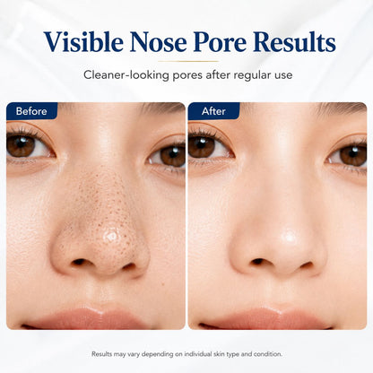 ELLEN ELLA Facial Blackhead Remover Pore Vacuum